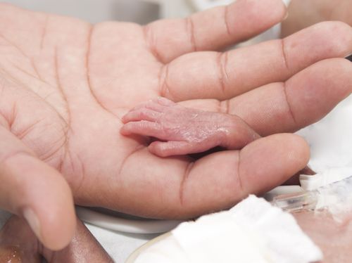 Bayi Prematur