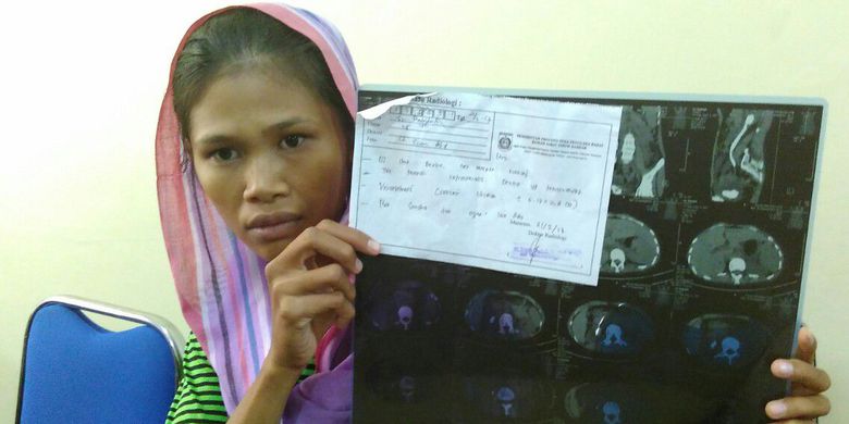 Sri Rabitah (25) mantan TKI asal Lombok, Nusa Tenggara Barat memperlihatkan hasil Rontgen ginjalnya.